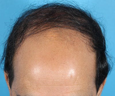 Hair Transplant Before & After Gallery - Patient 19340197 - Image 1