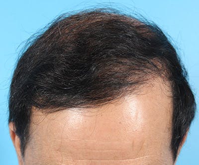 Hair Transplant Before & After Gallery - Patient 19340197 - Image 2
