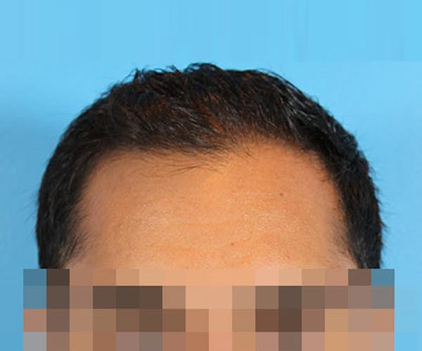 Hair Transplant Before & After Gallery - Patient 19340198 - Image 1