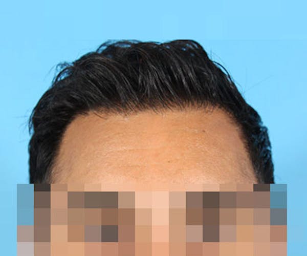 Hair Transplant Before & After Gallery - Patient 19340198 - Image 2