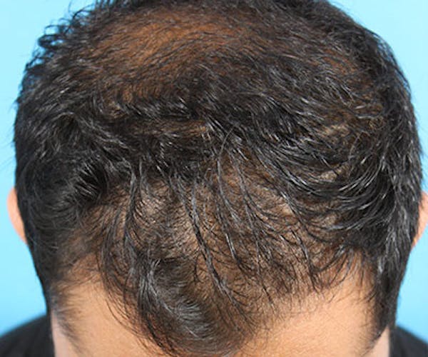 Hair Transplant Before & After Gallery - Patient 19340198 - Image 3