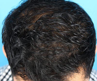 Hair Transplant Before & After Gallery - Patient 19340198 - Image 4