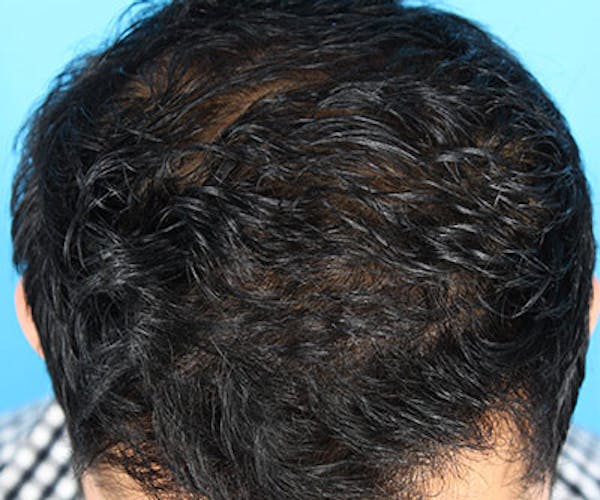 Hair Transplant Before & After Gallery - Patient 19340198 - Image 4
