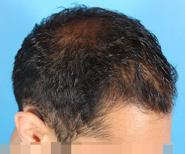 Hair Transplant Before & After Gallery - Patient 19340198 - Image 5
