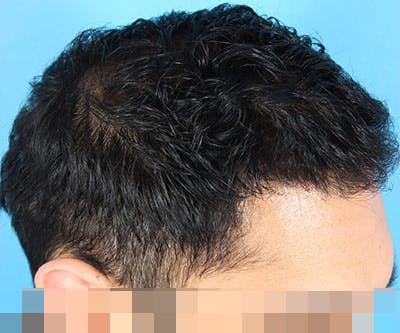 Hair Transplant Before & After Gallery - Patient 19340198 - Image 6