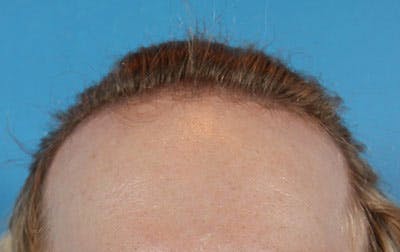 Hair Transplant Before & After Gallery - Patient 19340200 - Image 1