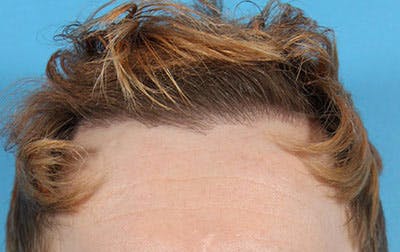 Hair Transplant Before & After Gallery - Patient 19340200 - Image 2