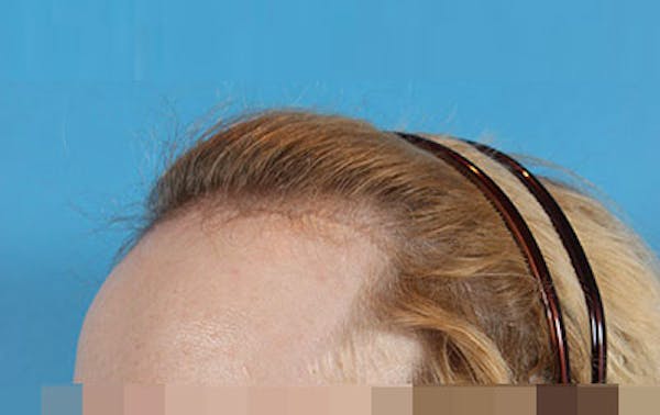 Hair Transplant Before & After Gallery - Patient 19340200 - Image 3