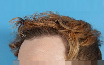 Hair Transplant Before & After Gallery - Patient 19340200 - Image 4