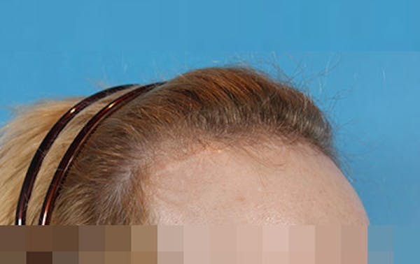 Hair Transplant Before & After Gallery - Patient 19340200 - Image 5