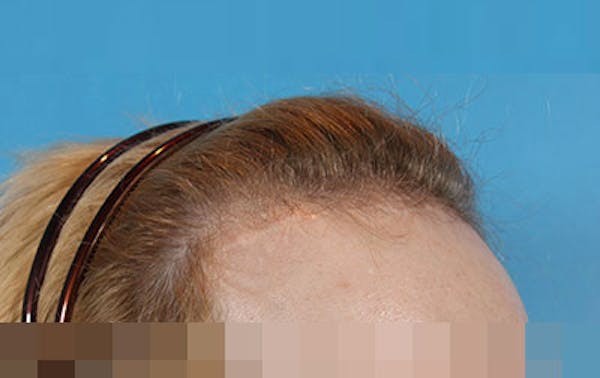 Hair Transplant Gallery - Patient 19340200 - Image 5