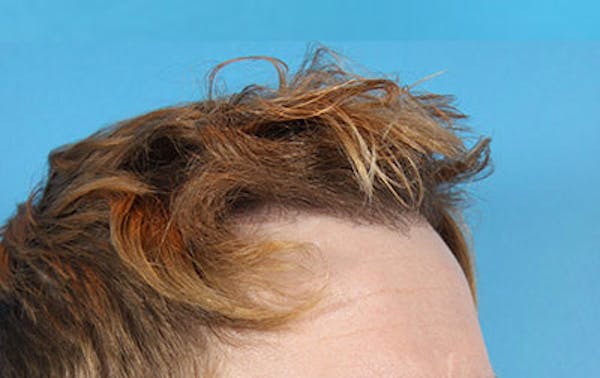 Hair Transplant Before & After Gallery - Patient 19340200 - Image 6