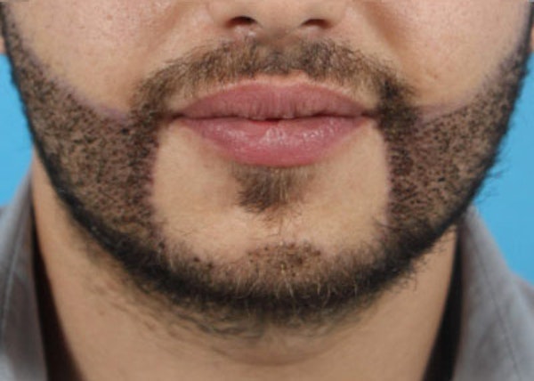 Beard Transplants in Toronto