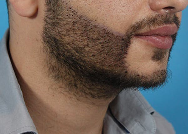 Hair Transplant Before & After Gallery - Patient 19340201 - Image 4