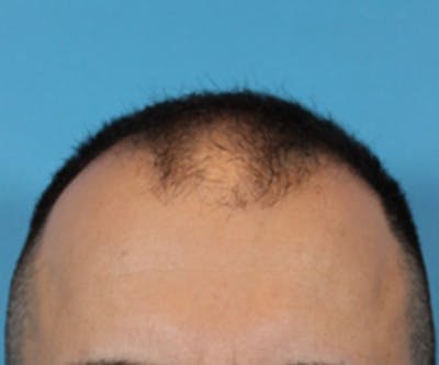 Hair Transplant Before & After Gallery - Patient 19340202 - Image 1