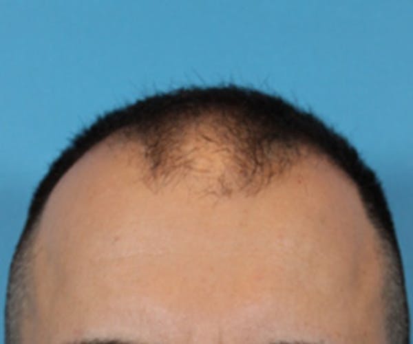 Hair Transplant Before & After Gallery - Patient 19340202 - Image 1