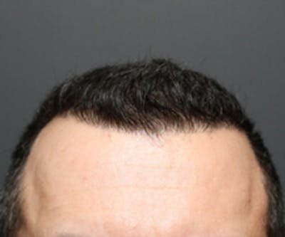 Hair Transplant Before & After Gallery - Patient 19340202 - Image 2