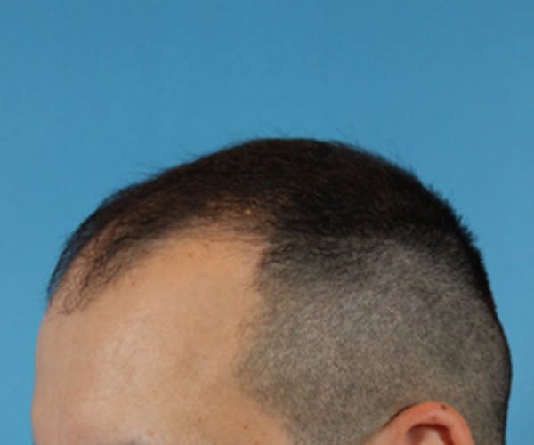 Hair Transplant Before & After Gallery - Patient 19340202 - Image 3