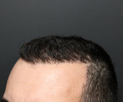 Hair Transplant Before & After Gallery - Patient 19340202 - Image 4