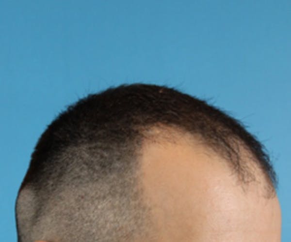 Hair Transplant Before & After Gallery - Patient 19340202 - Image 5