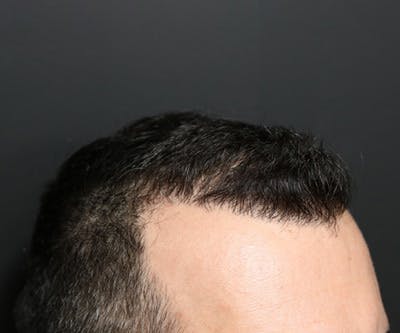 Hair Transplant Before & After Gallery - Patient 19340202 - Image 6