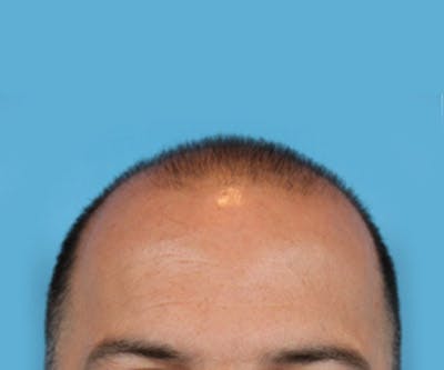 Hair Transplant Before & After Gallery - Patient 19340203 - Image 1