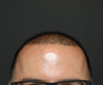 Hair Transplant Before & After Gallery - Patient 19340203 - Image 2