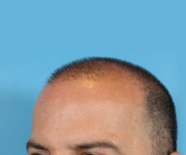 Hair Transplant Before & After Gallery - Patient 19340203 - Image 3
