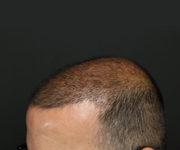 Hair Transplant Before & After Gallery - Patient 19340203 - Image 4
