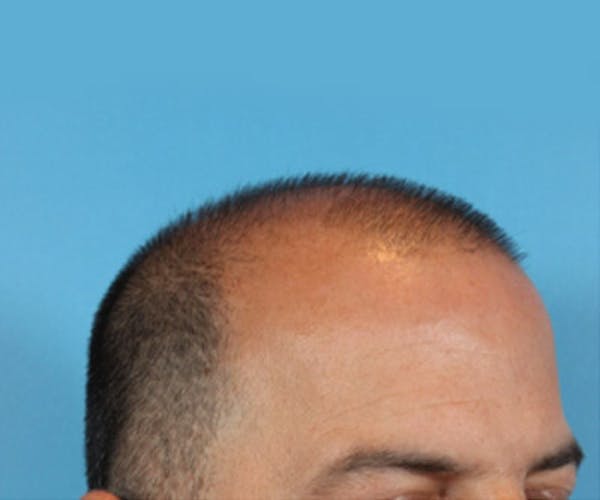Hair Transplant Before & After Gallery - Patient 19340203 - Image 5