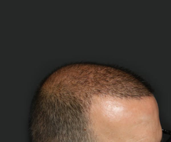 Hair Transplant Before & After Gallery - Patient 19340203 - Image 6