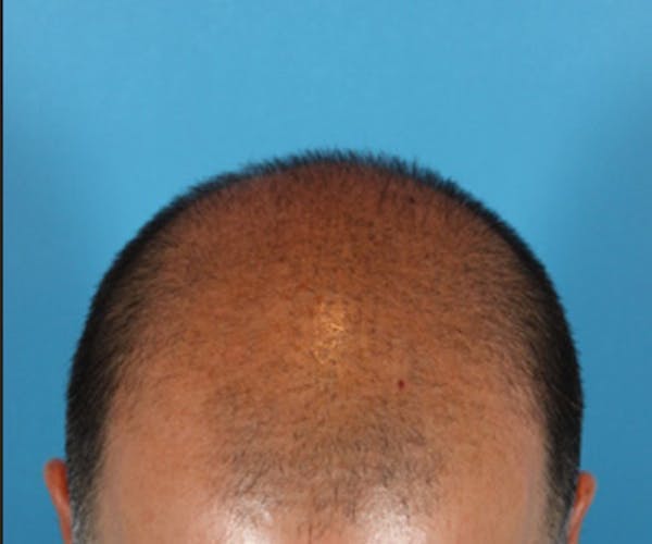 Hair Transplant Before & After Gallery - Patient 19340203 - Image 7