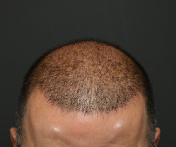 Hair Transplant Gallery - Patient 19340203 - Image 8