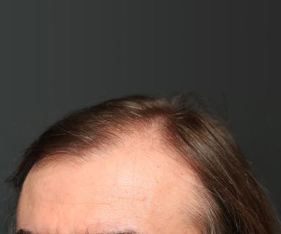 Hair Transplant Before & After Gallery - Patient 22263426 - Image 1