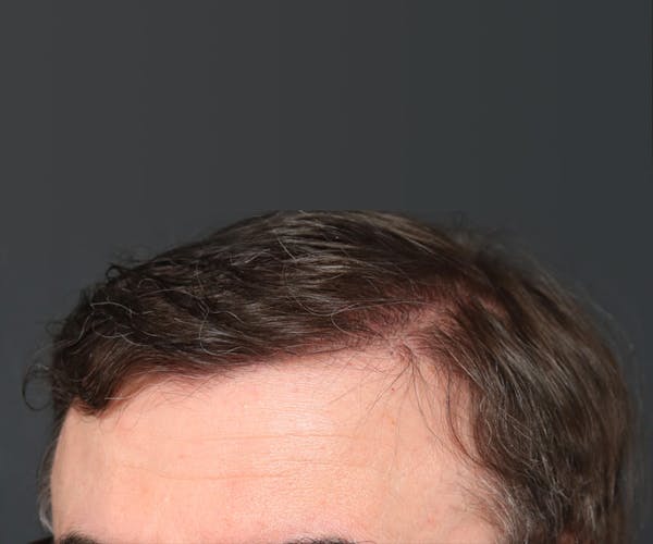 Hair Transplant Gallery - Patient 22263426 - Image 2