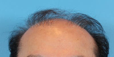 Hair Transplant Before & After Gallery - Patient 122227265 - Image 1