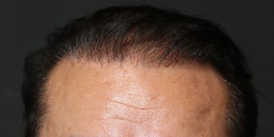 Hair Transplant Before & After Gallery - Patient 122227265 - Image 2