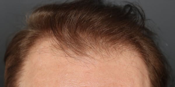 Hair Transplant Before & After Gallery - Patient 122227266 - Image 1