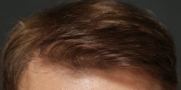 Hair Transplant Before & After Gallery - Patient 122227266 - Image 2