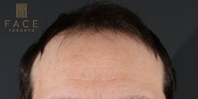 Hair Transplant Before & After Gallery - Patient 122227267 - Image 1