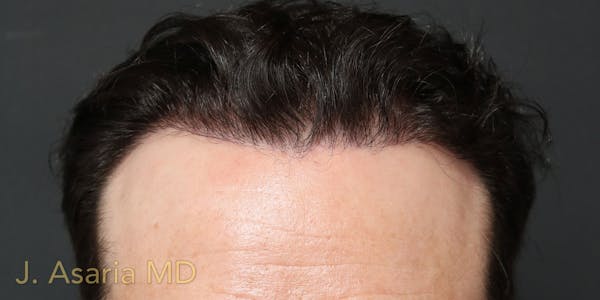 Hair Transplant Before & After Gallery - Patient 122227267 - Image 2