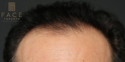 Hair Transplant Before & After Gallery - Patient 122227268 - Image 1
