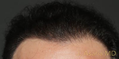 Hair Transplant Before & After Gallery - Patient 122227268 - Image 2
