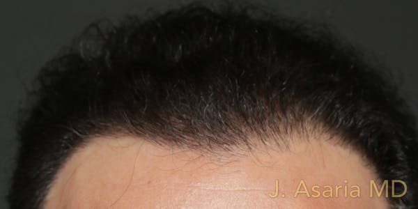Hair Transplant Before & After Gallery - Patient 122227268 - Image 2