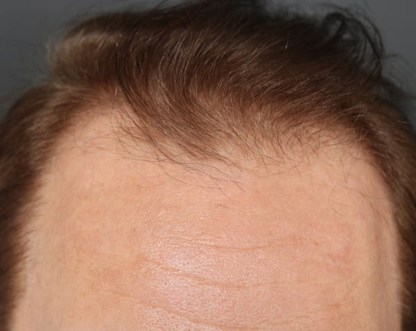Hair Transplant Before & After Gallery - Patient 122227269 - Image 1