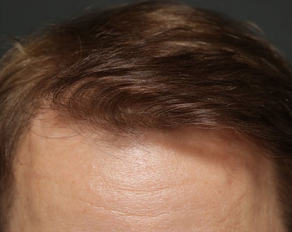 Hair Transplant Before & After Gallery - Patient 122227269 - Image 2