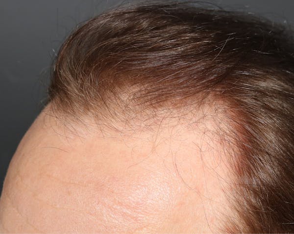 Hair Transplant Before & After Gallery - Patient 122227269 - Image 3