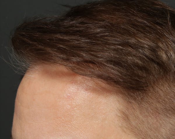Hair Transplant Before & After Gallery - Patient 122227269 - Image 4