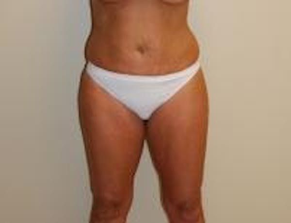 Liposuction Before & After Gallery - Patient 18618245 - Image 1