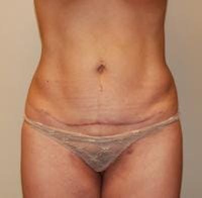 Tummy Tuck Before & After Gallery - Patient 22391067 - Image 2